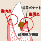 歯周病の説明