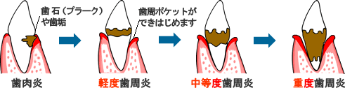 歯周病の進行